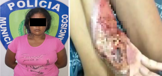 Quemó las manos de su hija por comerse unos alimentos en Zulia