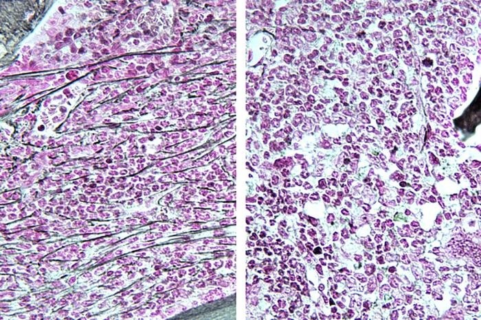 Fármaco en fase de ensayo para el cáncer de mama también podría tratar algunos cánceres sanguíneos, según un estudio